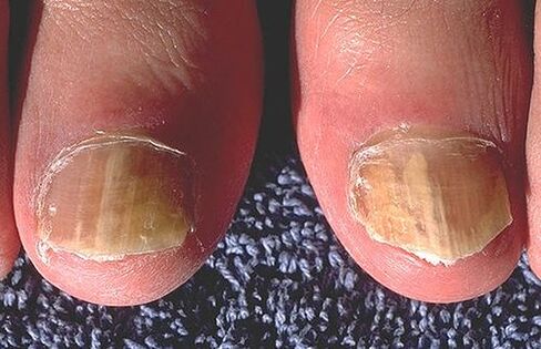 Dermatitoek eragindako iltzeak